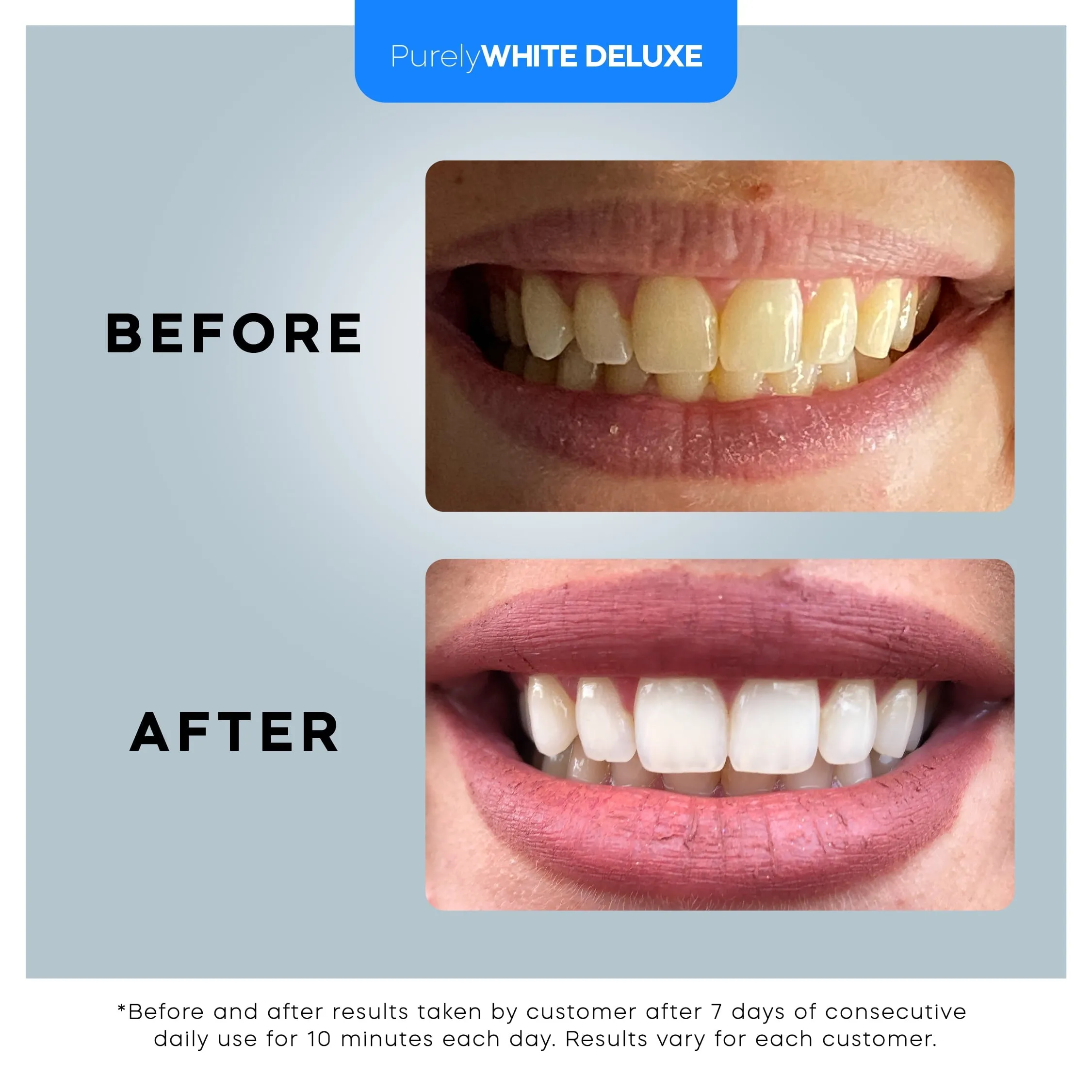 PurelyWHITE Deluxe Teeth Whitening Kit